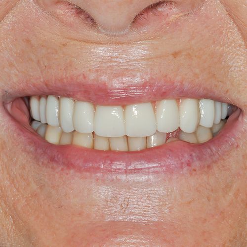 After - Smile in a day - Dara Fahy - 3dental